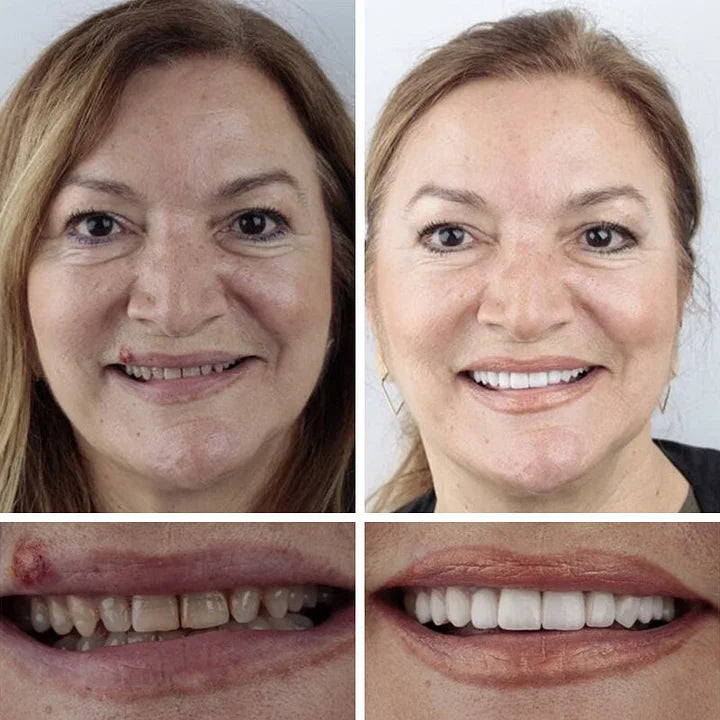 SmileLock – Vollprothese mit starkem Saugsitz