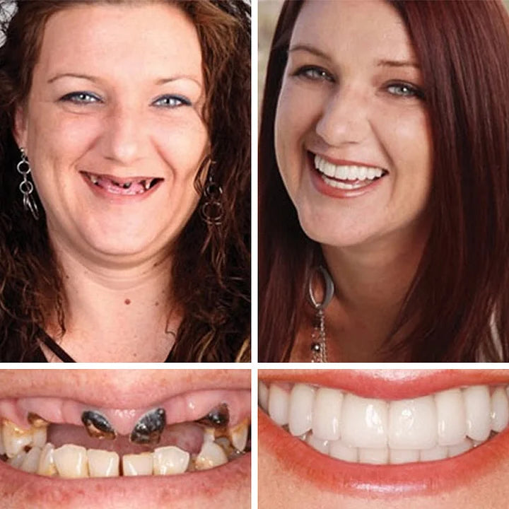 SmileLock – Vollprothese mit starkem Saugsitz